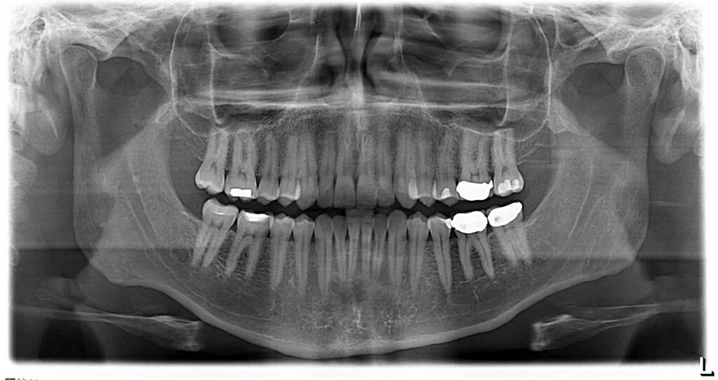 Radiografía panorámica digital de una dentadura completa